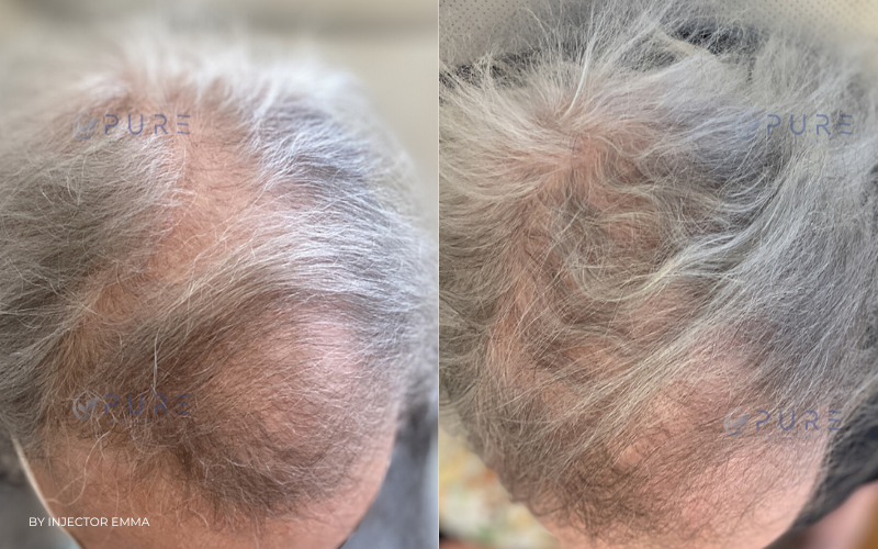 Platelet-rich plasma (PRP) injections for Alopecia