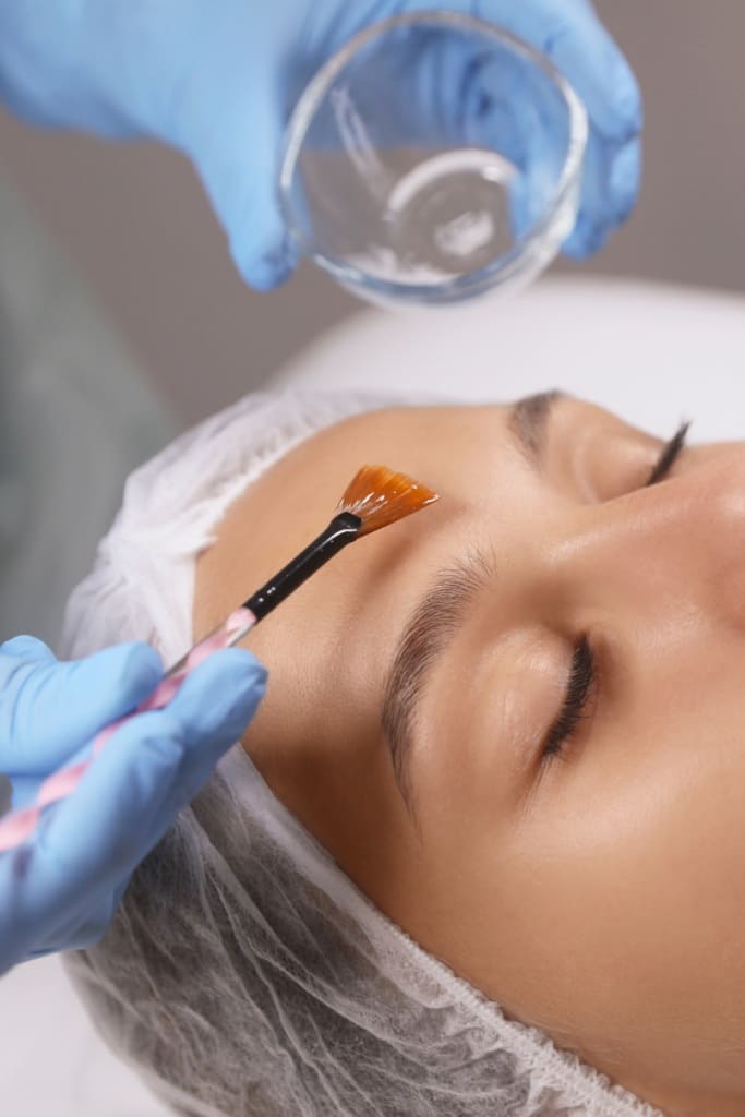 Chemical Peels Stamford