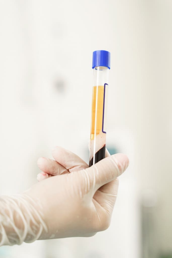 PRP Injections