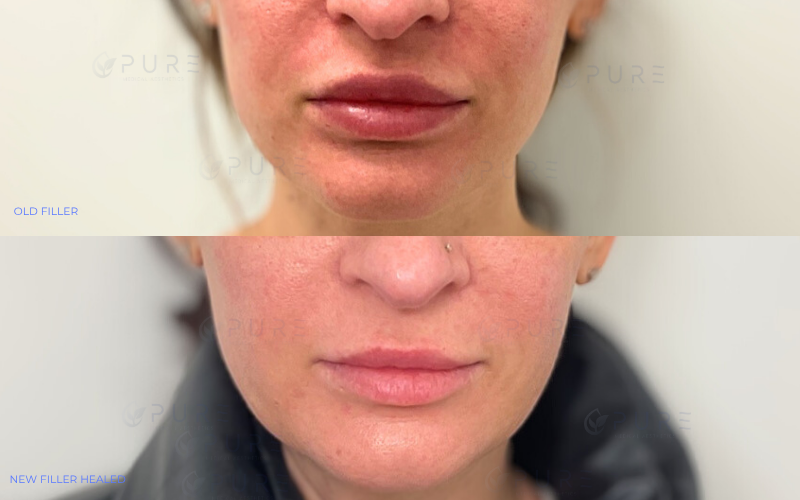 Filler Removal
