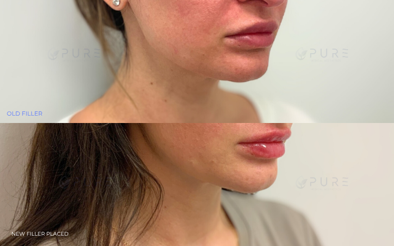 Filler Removal