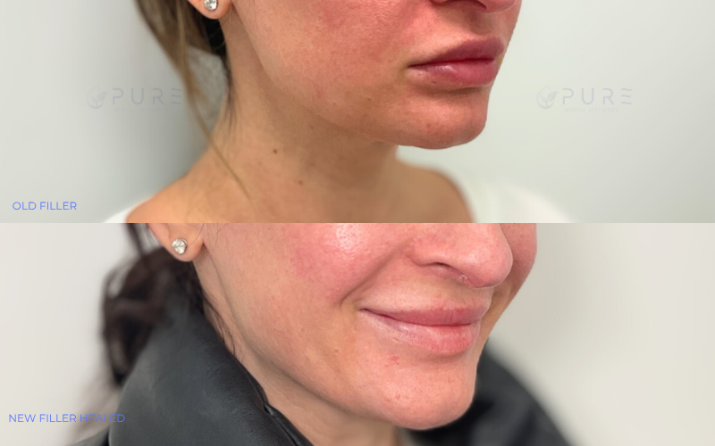 Filler Removal