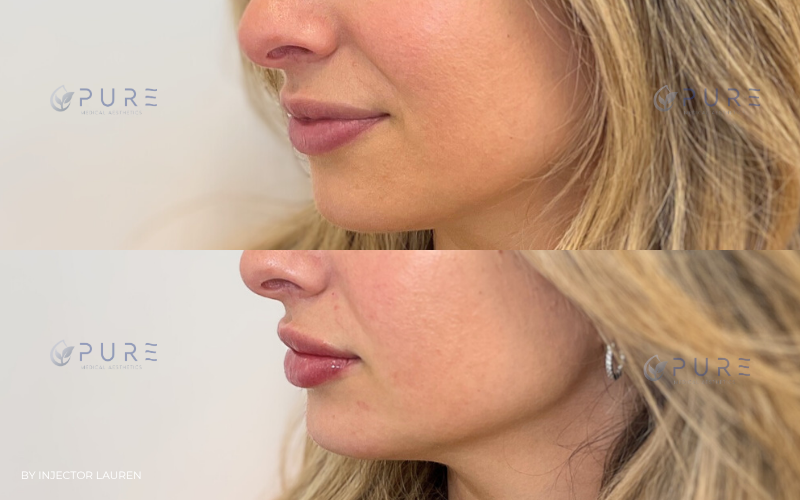 Lip filler | Hyaluronic Acid Fillers