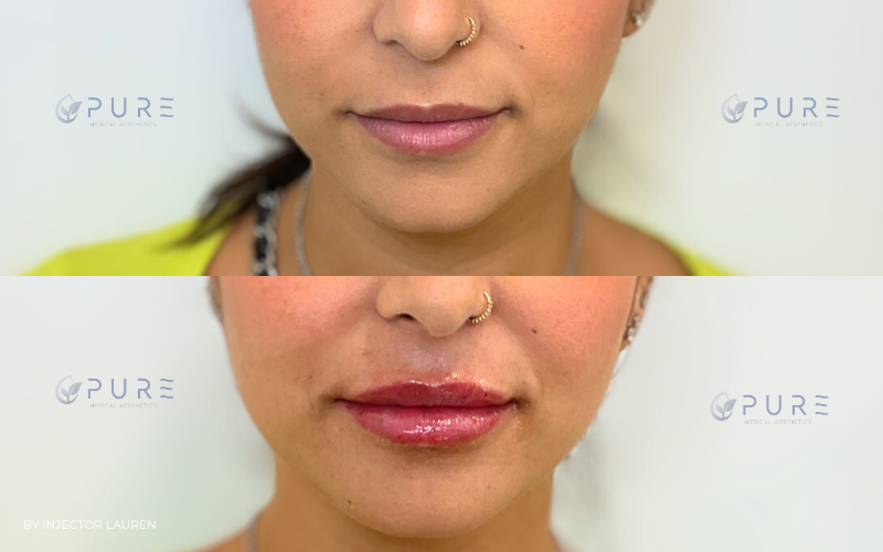 Lip filler | Hyaluronic Acid Fillers