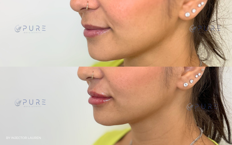 Lip filler | Hyaluronic Acid Fillers