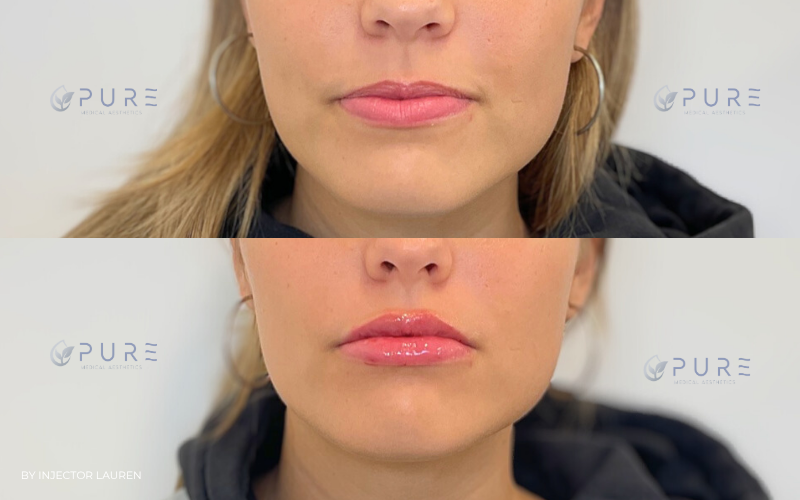 Lip filler | Hyaluronic Acid Fillers