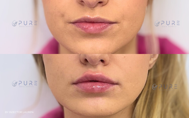 Lip filler | Hyaluronic Acid Fillers
