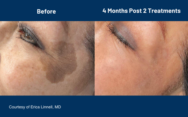 side by side comparison of skin before and after the Ultraclear treatment