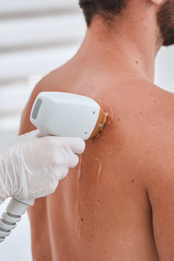 Laser Hair Removal