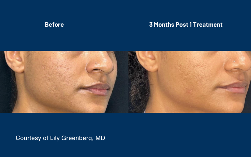 side by side comparison of skin before and after the Ultraclear treatment