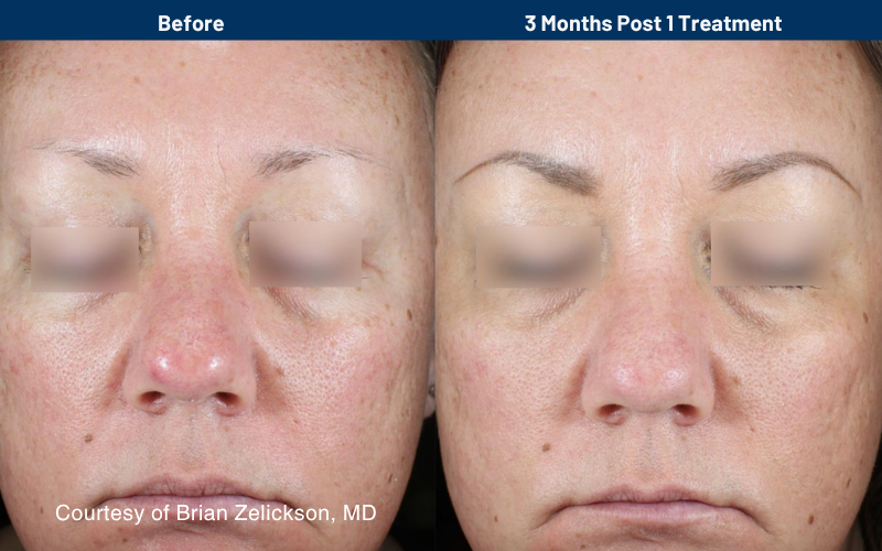 side by side comparison of skin before and after the Ultraclear treatment