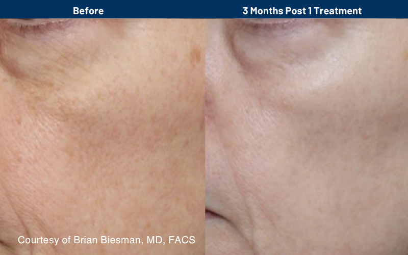 side by side comparison of skin before and after the Ultraclear treatment
