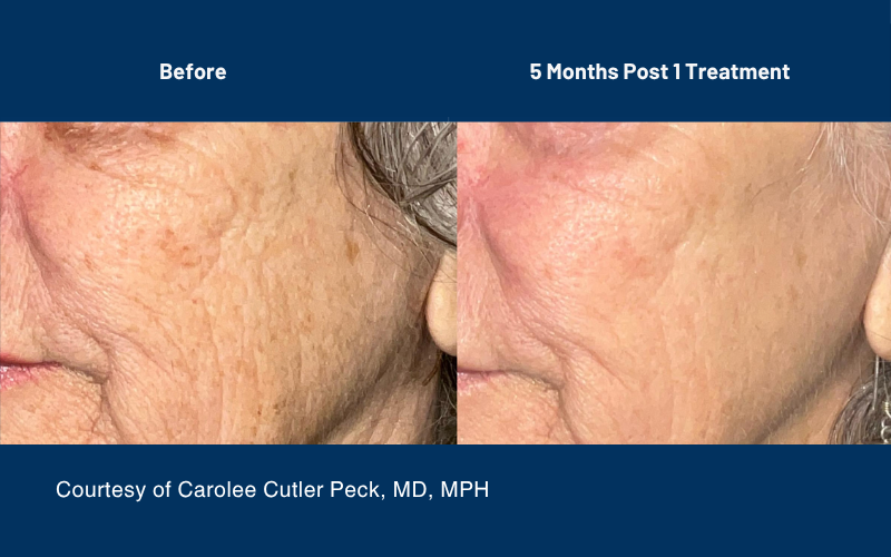 side by side comparison of skin before and after the Ultraclear treatment