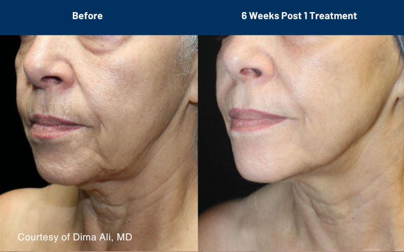 side by side comparison of skin before and after the Ultraclear treatment