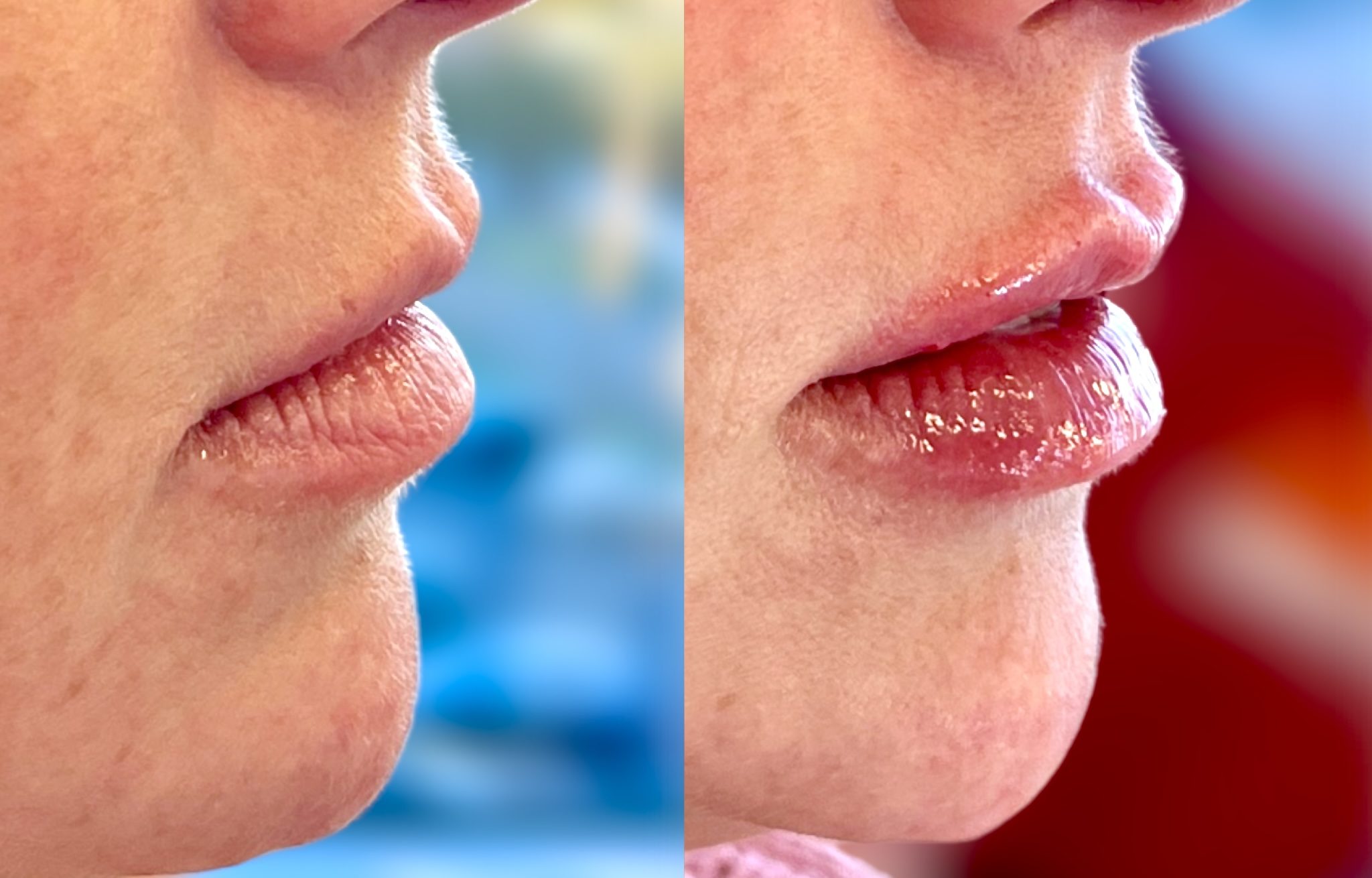 Lip filler | Hyaluronic Acid Fillers