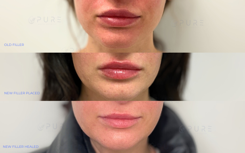 Filler Removal