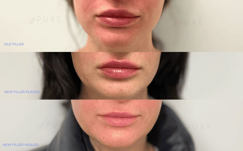 Filler Removal