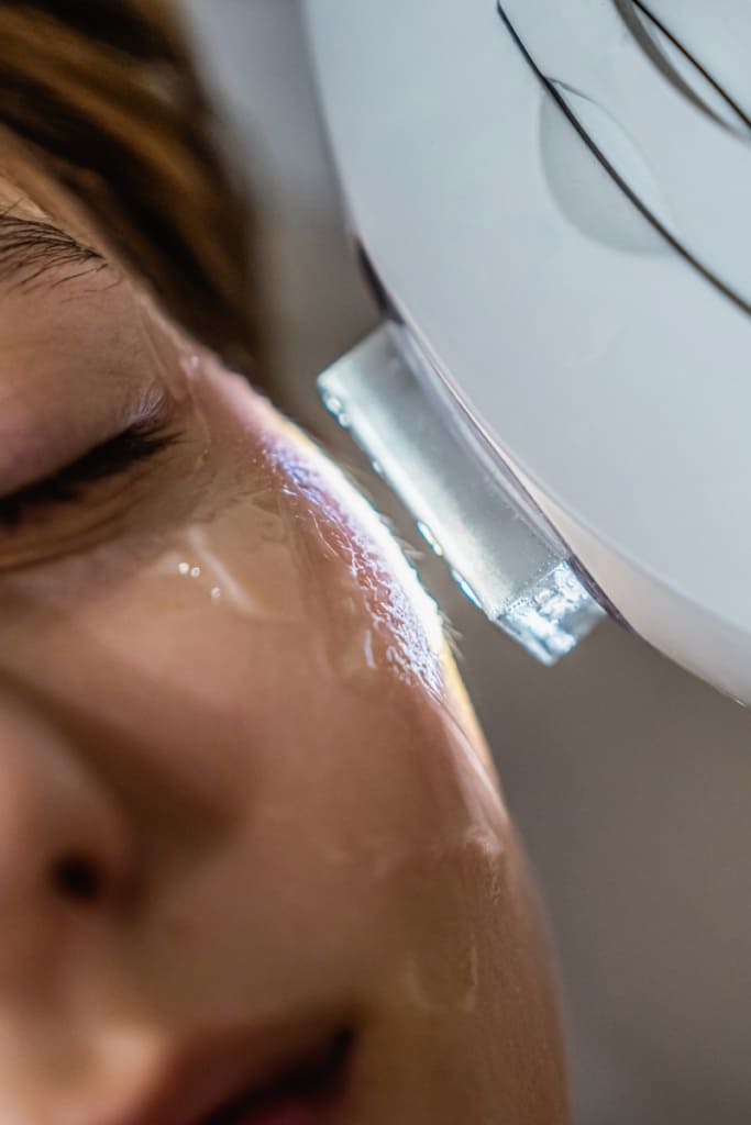 IPL photofacial (Intense Pulsed Light)