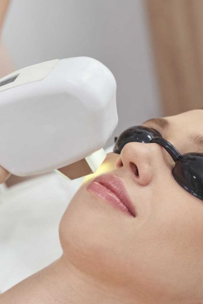 IPL photofacial (Intense Pulsed Light)