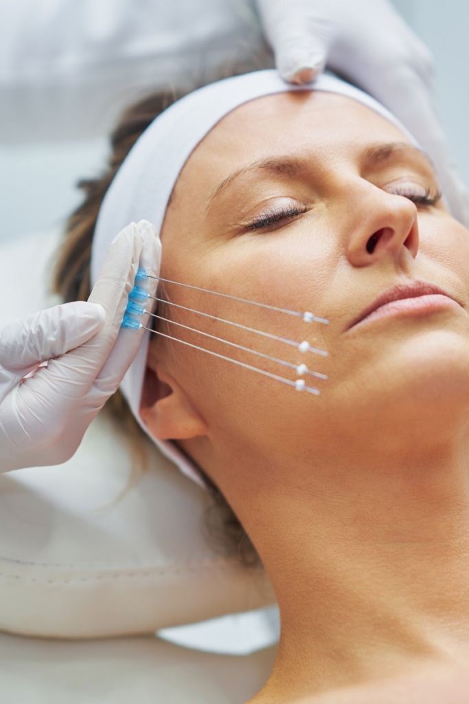 PDO Threadlift