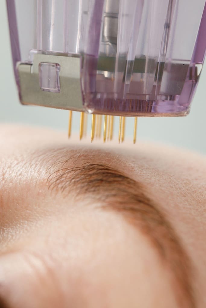 RF Microneedling