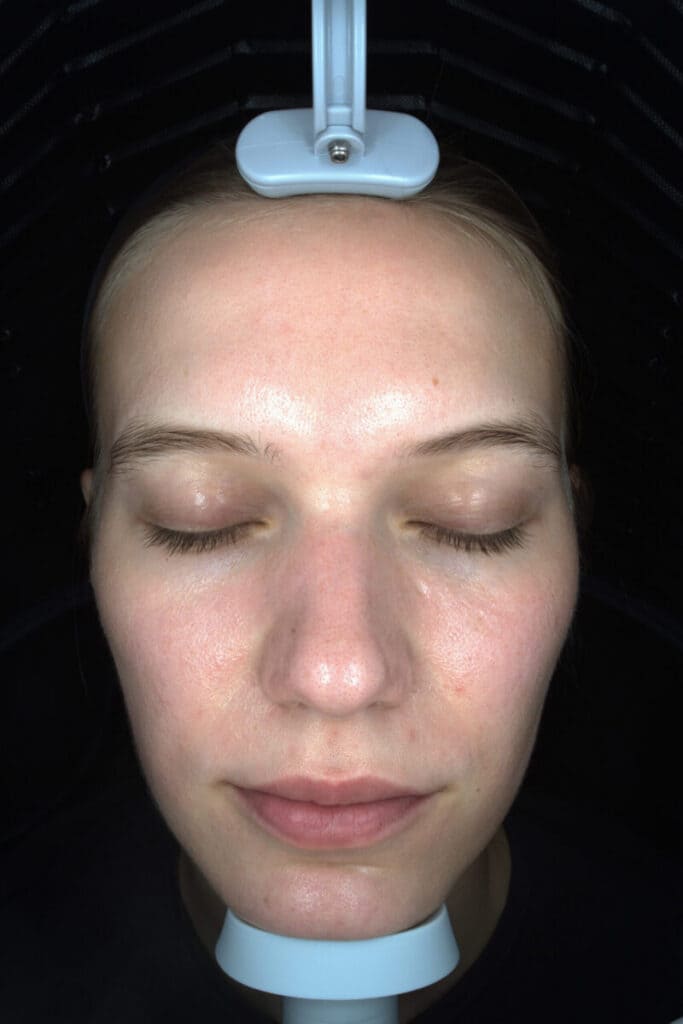 Skin Analysis