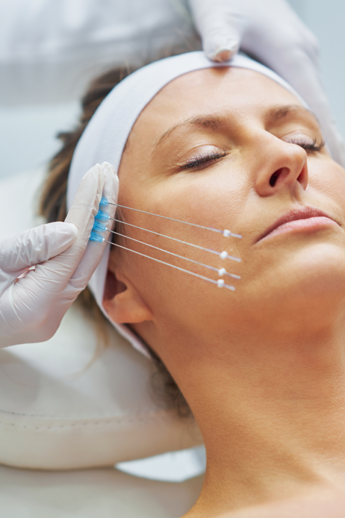 PDO Threadlift